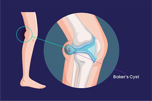 دویدن کیست بیکر (Baker's Cyst)