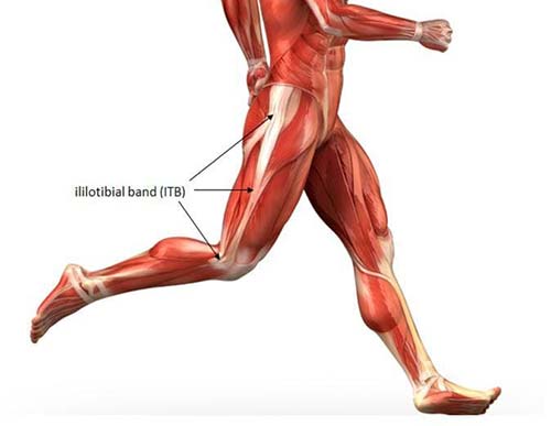 دویدن سندروم نوار ایلیوتیبیال (Iliotibial Band Syndrome - ITBS)