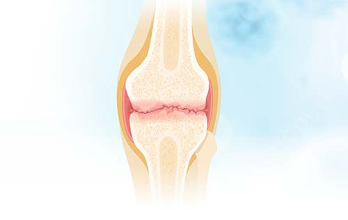 دویدن آرتروز (Osteoarthritis)