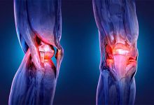 دارو 8 بهترین داروی گیاهی برای خشکی مفاصل (و نکات مصرف)